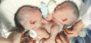 连体婴是如何形成的 罕见畸形连体婴姐妹分离变美女 4