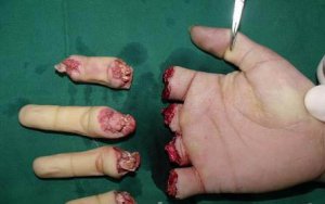 女工10根手指被电锯锯断 及时手术21小时全部接活