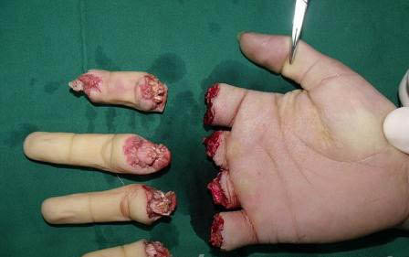 女工10根手指被电锯锯断 及时手术21小时全部接活 1